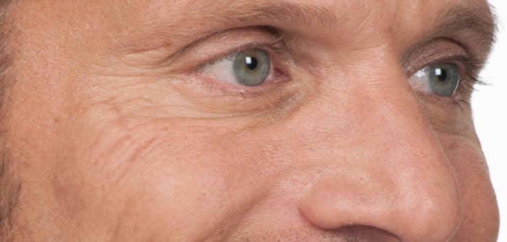 After: frown lines softened with anti-wrinkle treatment