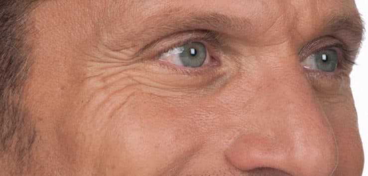 Before: frown lines softened with anti-wrinkle treatment