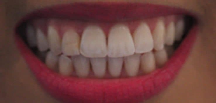 After: teeth straightened with Invisalign