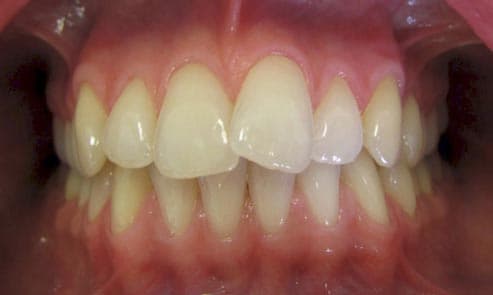 Before: front teeth straightened with Invisalign