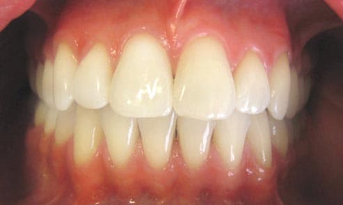 After: front teeth straightened with Invisalign