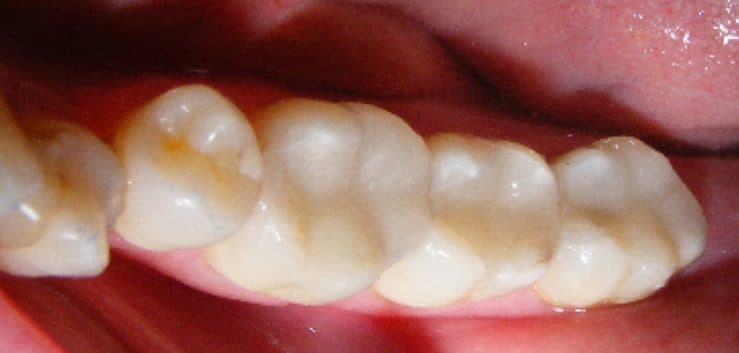 After: silver fillings replaced with white fillings
