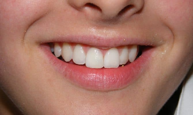 After: a discoloured front tooth whitened
