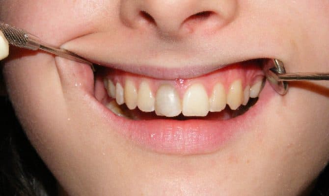 Before: a discoloured front tooth whitened