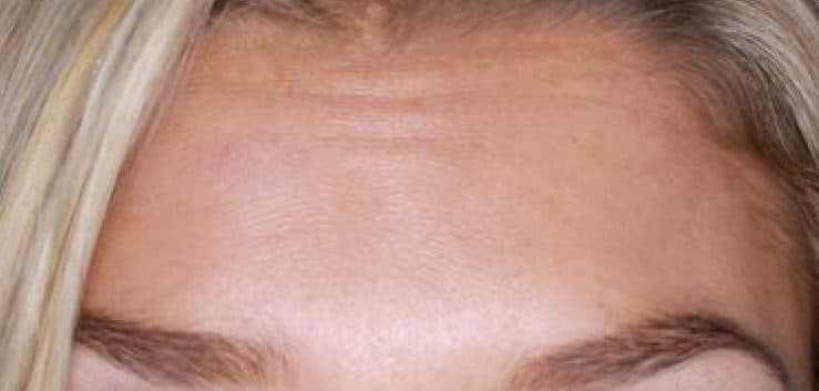 After: forehead lines softened with anti-wrinkle treatment