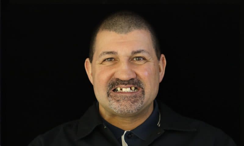 Before: implant restoration