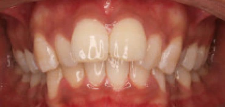 Before: teeth straightened with Invisalign
